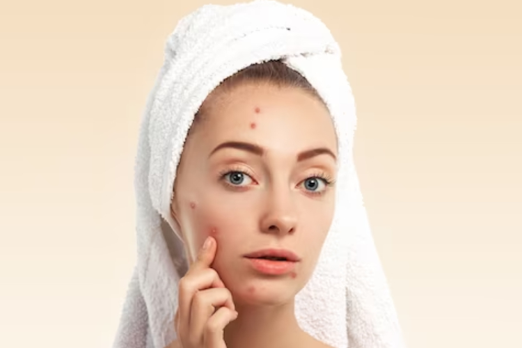 Acne treatment in delhi